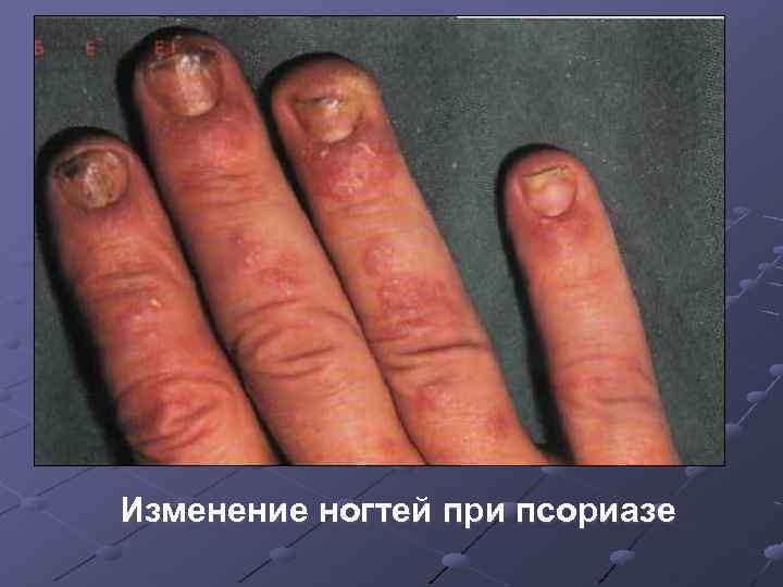 Изменение ногтей при псориазе 