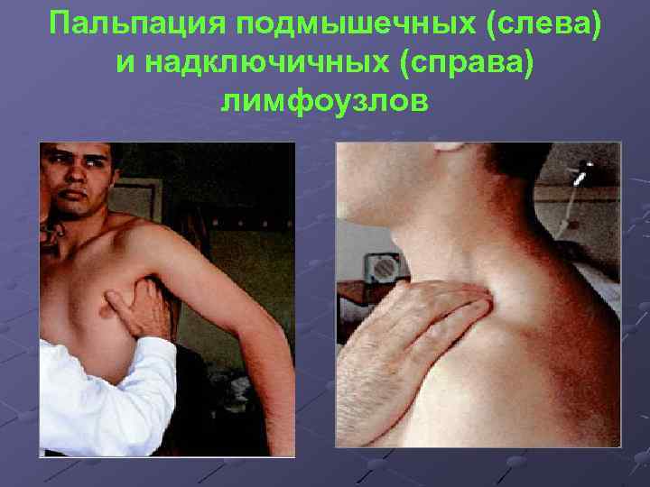 Пальпация подмышечных (слева) и надключичных (справа) лимфоузлов 