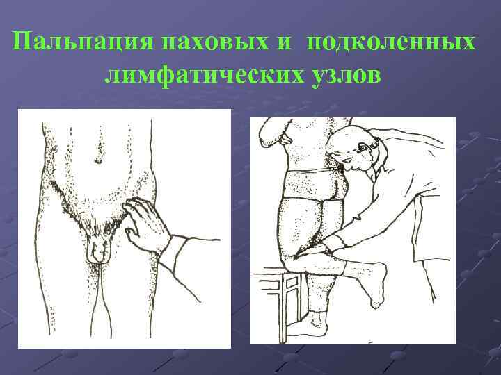 Пальпация паховых и подколенных лимфатических узлов 