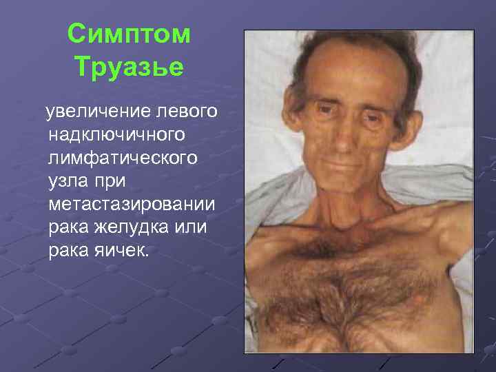 Симптом Труазье увеличение левого надключичного лимфатического узла при метастазировании рака желудка или рака яичек.