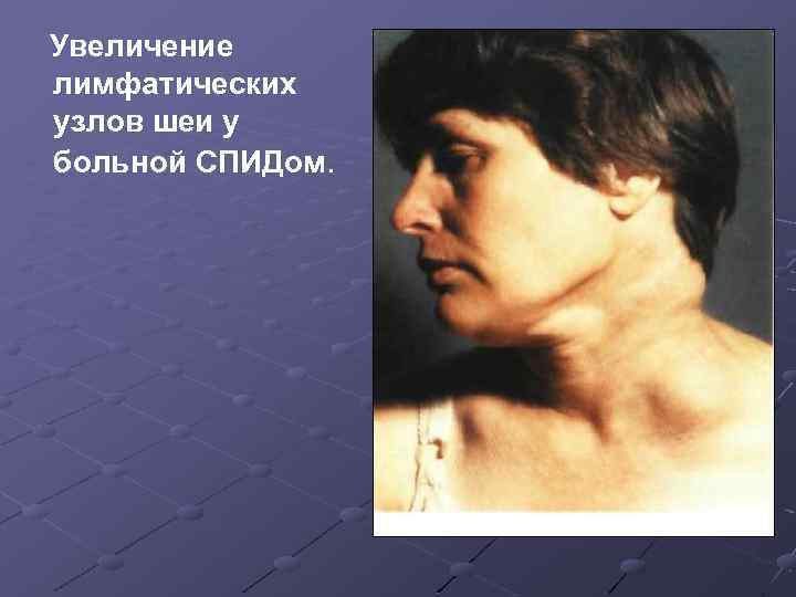 Увеличение лимфатических узлов шеи у больной СПИДом. 