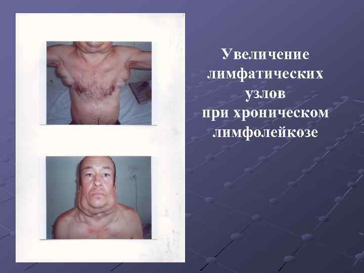 Увеличение лимфатических узлов при хроническом лимфолейкозе 