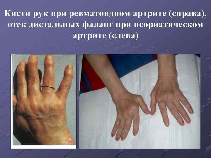 Кисти рук при ревматоидном артрите (справа), отек дистальных фаланг при псориатическом артрите (слева) 