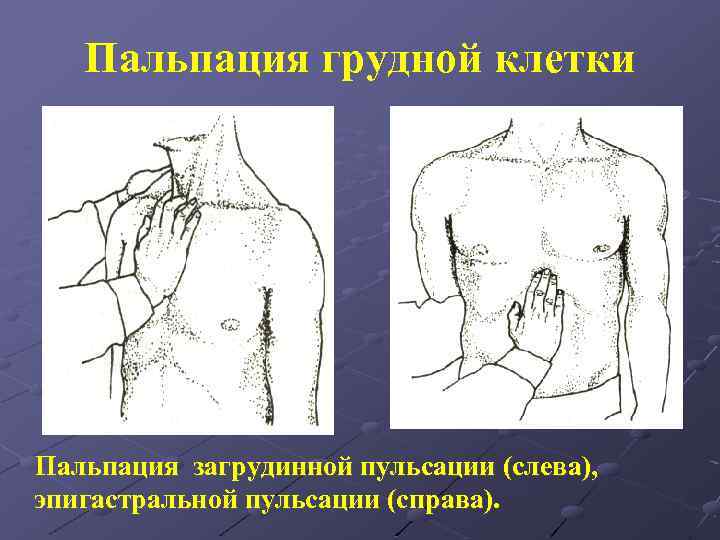 Пальпация грудной клетки Пальпация загрудинной пульсации (слева), эпигастральной пульсации (справа). 