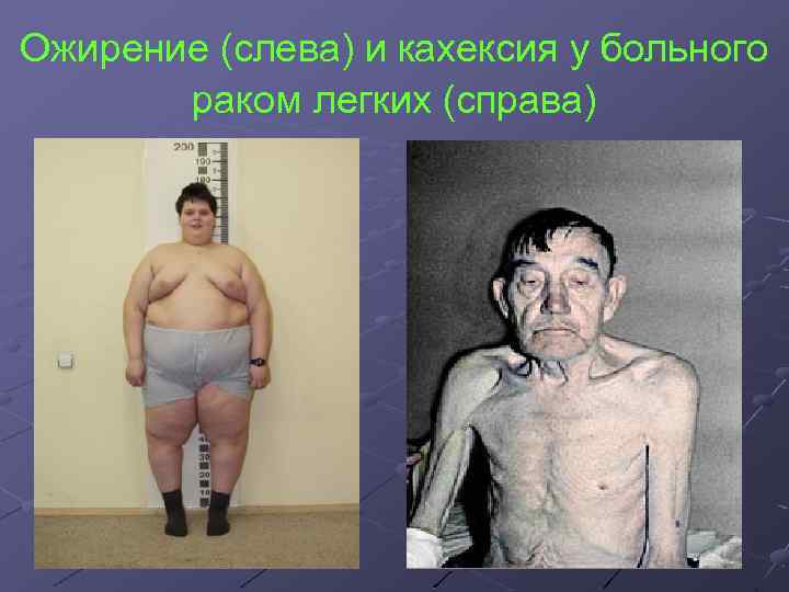 Ожирение (слева) и кахексия у больного раком легких (справа) 
