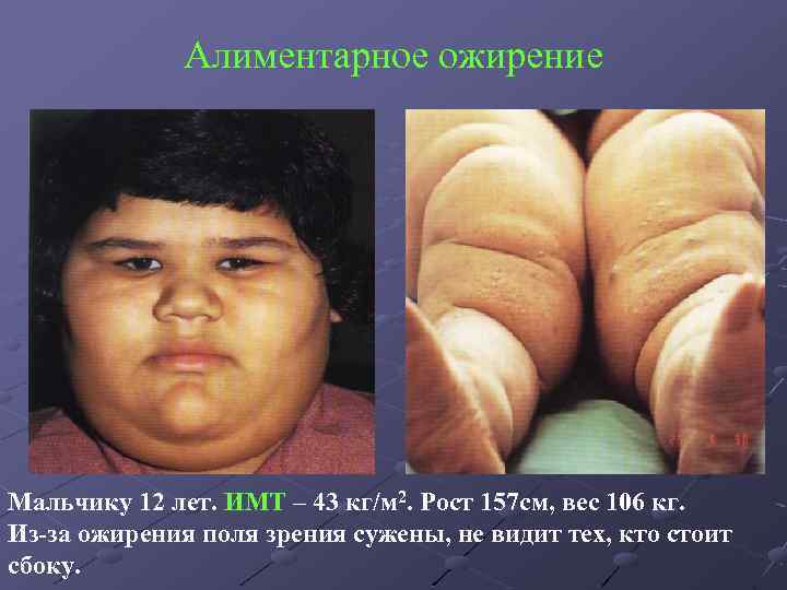Алиментарное ожирение Мальчику 12 лет. ИМТ – 43 кг/м 2. Рост 157 см, вес