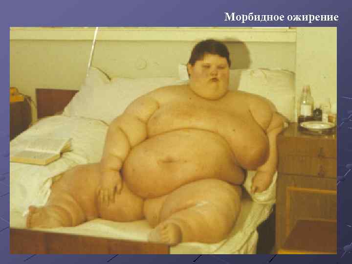Морбидное ожирение 