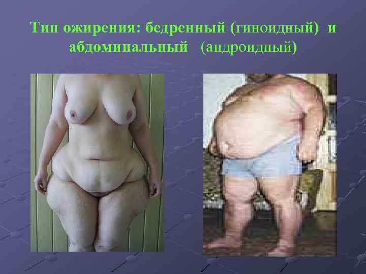 Тип ожирения: бедренный (гиноидный) и абдоминальный (андроидный) 