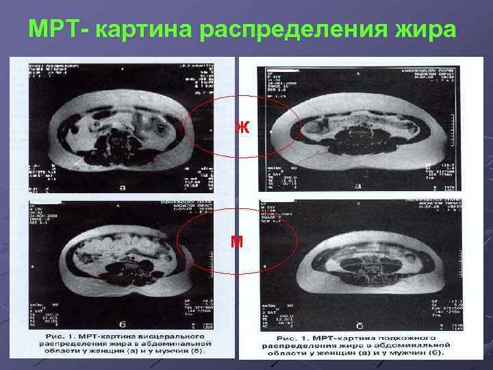 Распределение жира