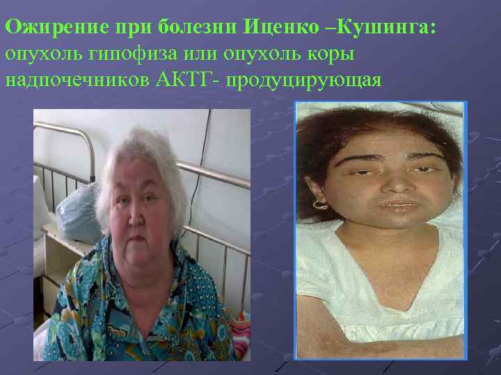 Ожирение при болезни Иценко –Кушинга: опухоль гипофиза или опухоль коры надпочечников АКТГ- продуцирующая 