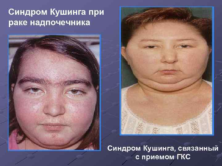 Синдром Кушинга при раке надпочечника Синдром Кушинга, связанный с приемом ГКС 