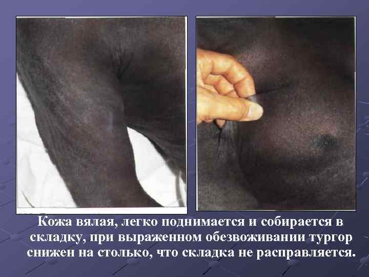 Кожа вялая, легко поднимается и собирается в складку, при выраженном обезвоживании тургор снижен на