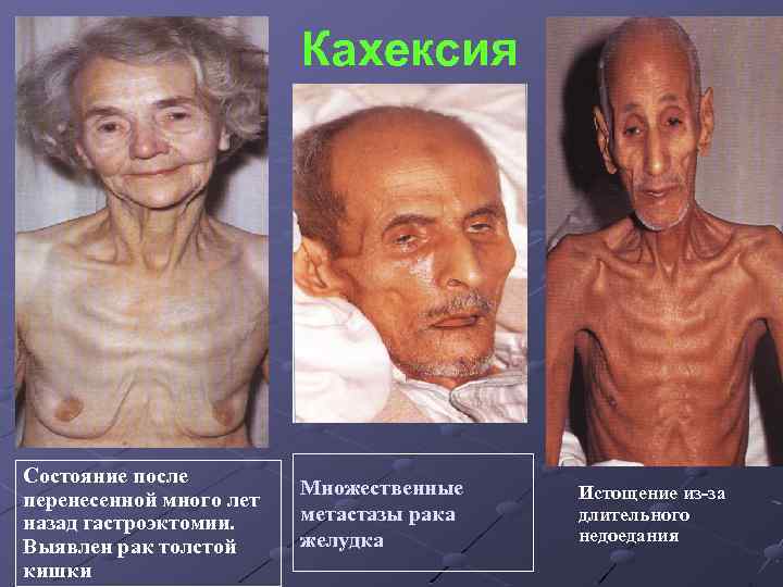 Кахексия Состояние после перенесенной много лет назад гастроэктомии. Выявлен рак толстой кишки Множественные метастазы
