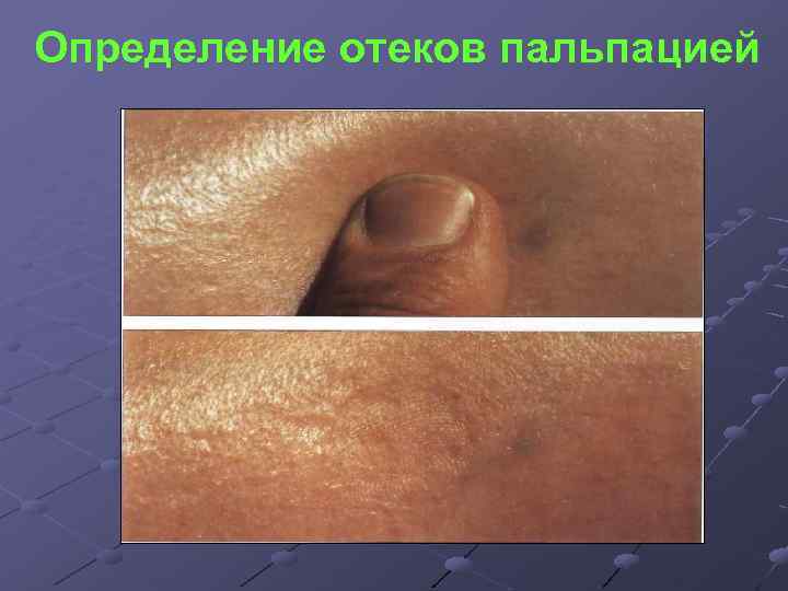 Определение отеков пальпацией 