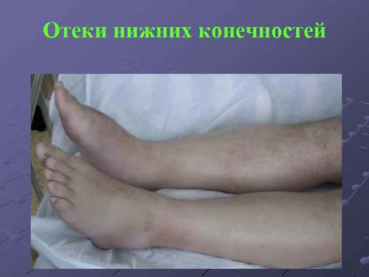 Отеки нижних конечностей 