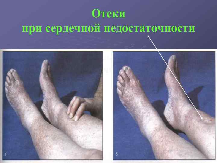 Отеки при сердечной недостаточности 