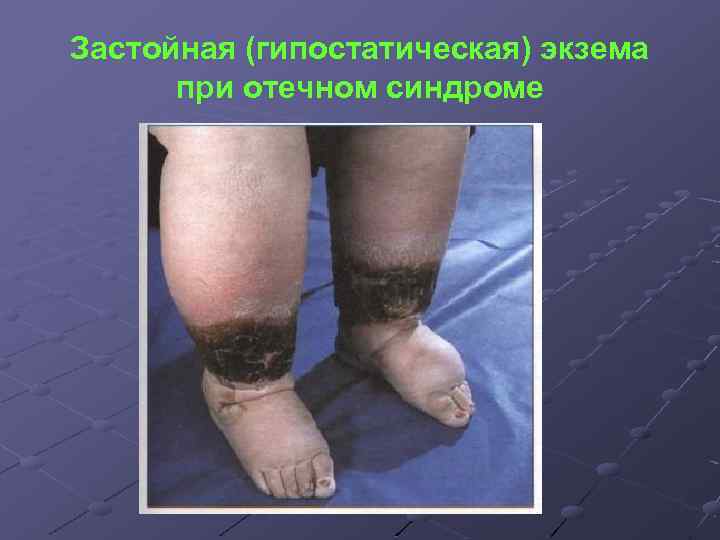 Застойная (гипостатическая) экзема при отечном синдроме 