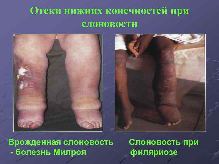 Отеки нижних конечностей при слоновости Врожденная слоновость - болезнь Милроя Слоновость при филяриозе 