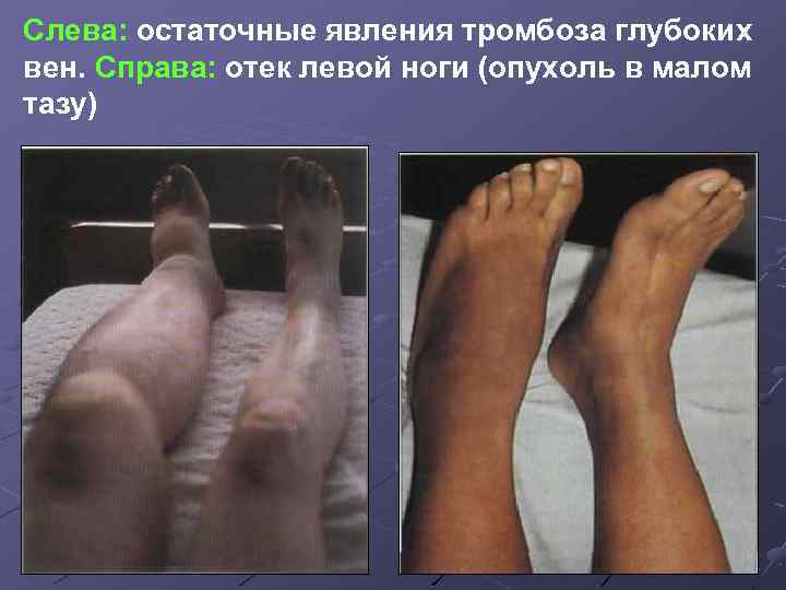 Тромбоз ног фото