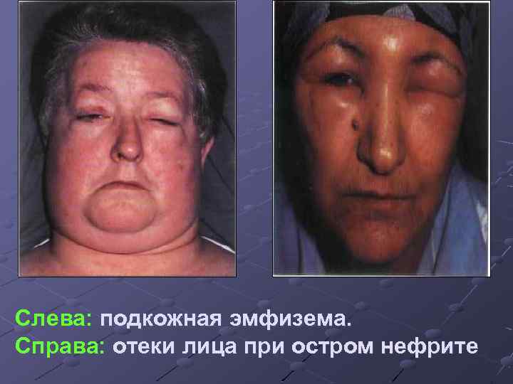 Слева: подкожная эмфизема. Справа: отеки лица при остром нефрите 