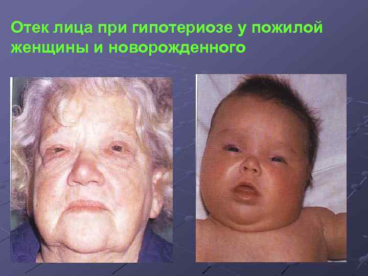 Отек лица при гипотериозе у пожилой женщины и новорожденного 