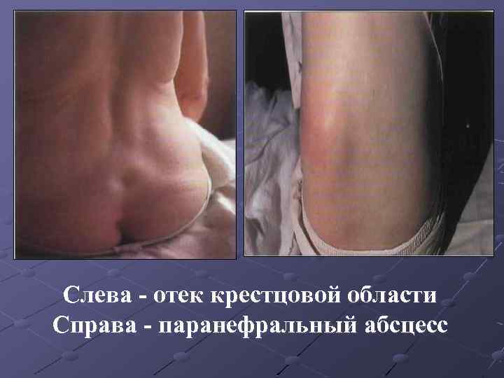 Слева - отек крестцовой области Справа - паранефральный абсцесс 