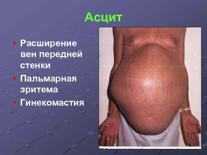 Асцит § Расширение вен передней стенки § Пальмарная эритема § Гинекомастия 