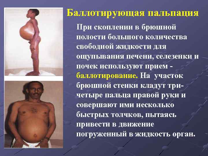 Баллотирующая пальпация При скоплении в брюшной полости большого количества свободной жидкости для ощупывания печени,