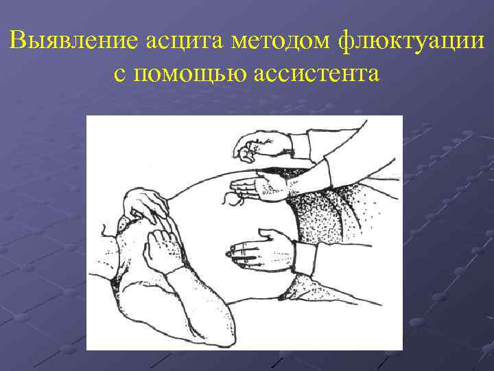 Выявление асцита методом флюктуации с помощью ассистента 