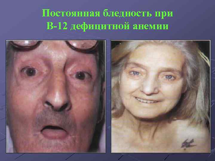 Постоянная бледность при В-12 дефицитной анемии 