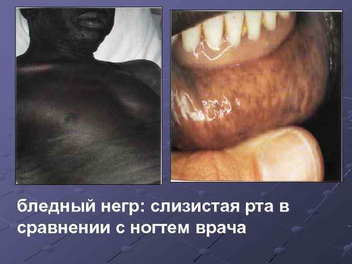 бледный негр: слизистая рта в сравнении с ногтем врача 
