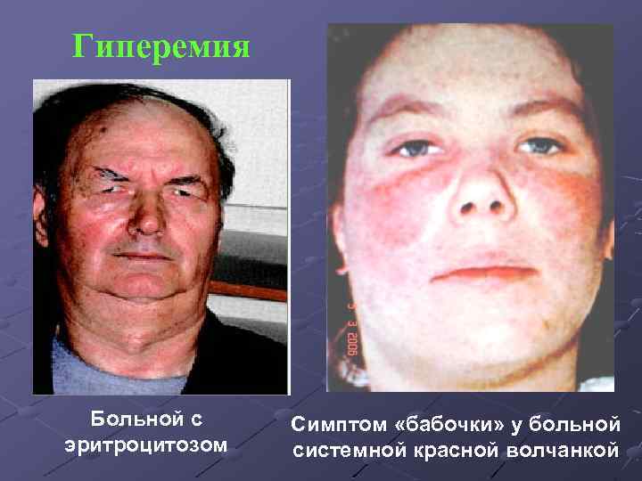 Гиперемия Больной с эритроцитозом Симптом «бабочки» у больной системной красной волчанкой 