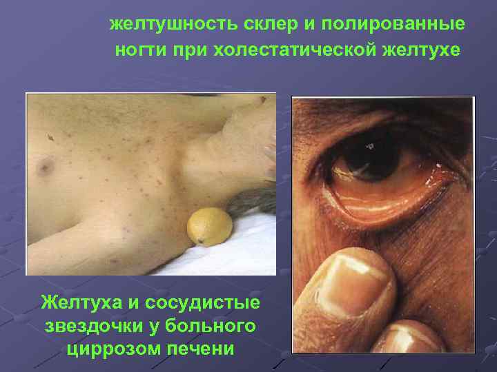 желтушность склер и полированные ногти при холестатической желтухе Желтуха и сосудистые звездочки у больного