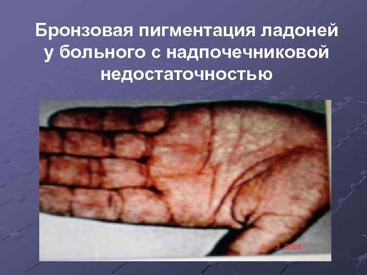 Бронзовая пигментация ладоней у больного с надпочечниковой недостаточностью 