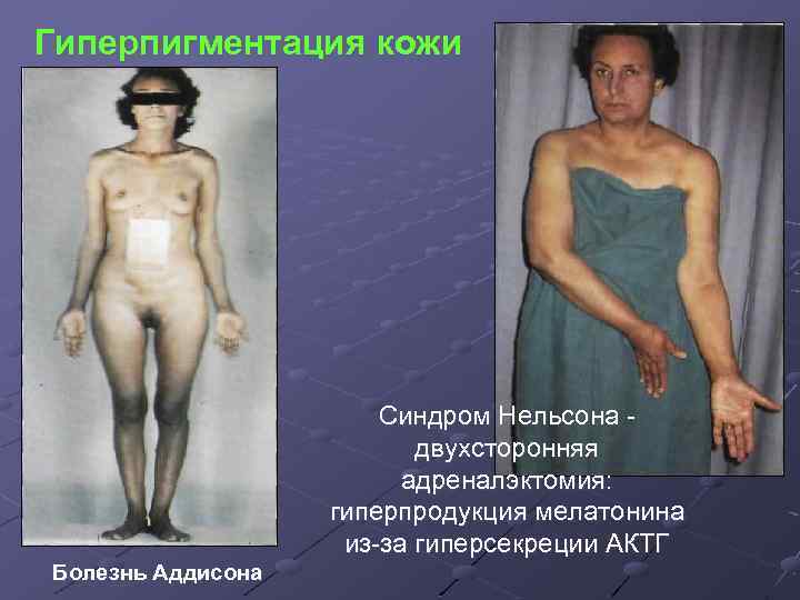 Гиперпигментация кожи Синдром Нельсона двухсторонняя адреналэктомия: гиперпродукция мелатонина из-за гиперсекреции АКТГ Болезнь Аддисона 