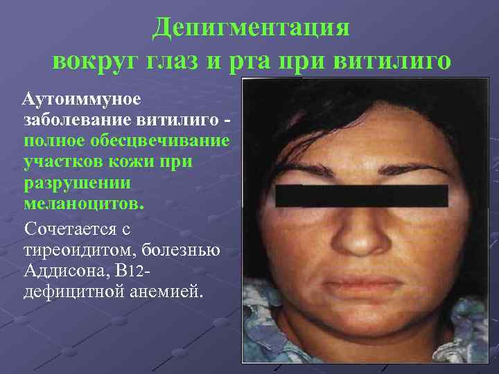 Депигментация вокруг глаз и рта при витилиго Аутоиммуное заболевание витилиго полное обесцвечивание участков кожи