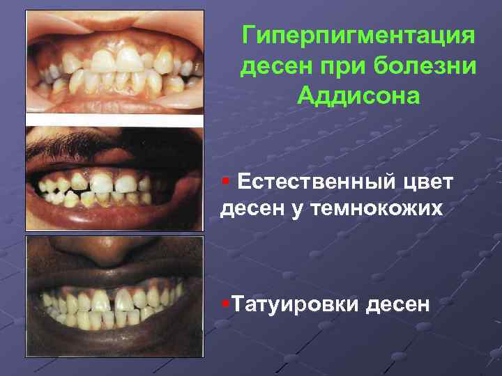 Гиперпигментация десен при болезни Аддисона § Естественный цвет десен у темнокожих §Татуировки десен 