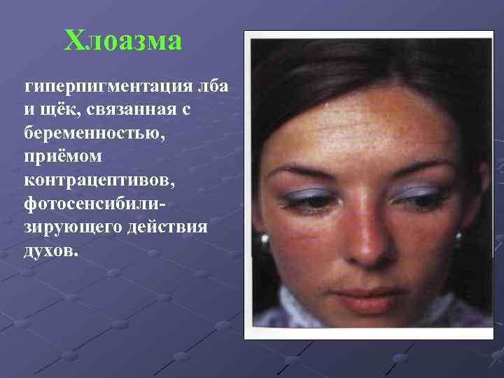 Хлоазма гиперпигментация лба и щёк, связанная с беременностью, приёмом контрацептивов, фотосенсибилизирующего действия духов. 