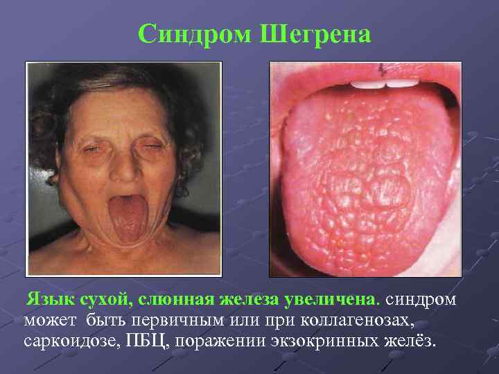 Синдром Шегрена Язык сухой, слюнная железа увеличена. синдром может быть первичным или при коллагенозах,