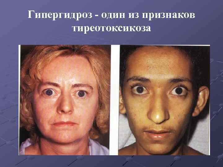 Гипергидроз - один из признаков тиреотоксикоза 
