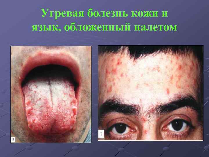 Угревая болезнь кожи и язык, обложенный налетом 