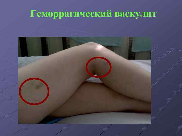 Геморрагический васкулит 