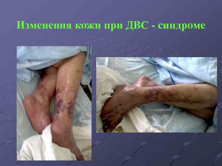 Изменения кожи при ДВС - синдроме 