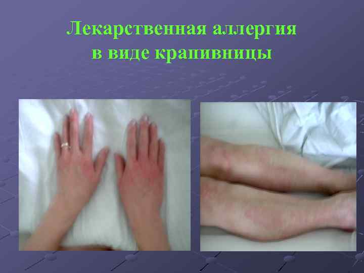 Лекарственная аллергия в виде крапивницы 