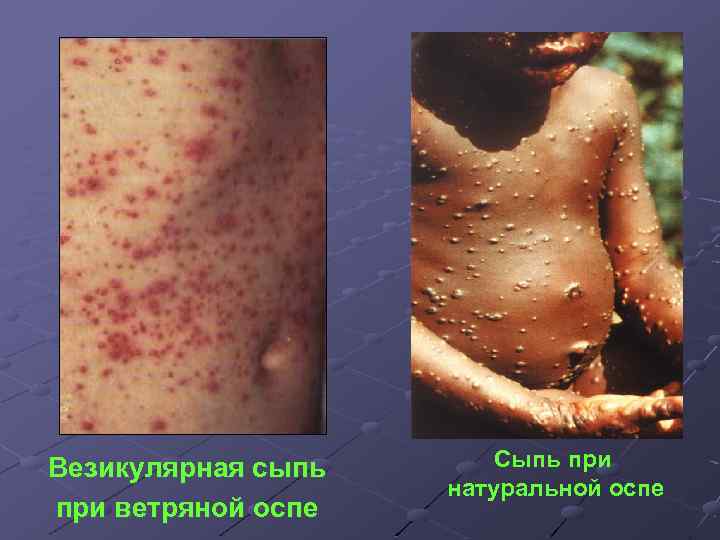 Везикулярная сыпь при ветряной оспе Сыпь при натуральной оспе 