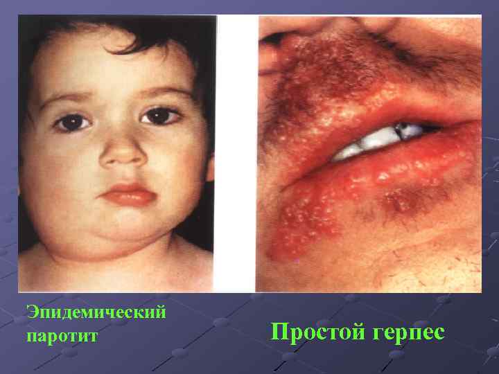 Эпидемический паротит Простой герпес 