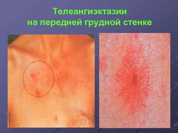 Телеангиэктазии на передней грудной стенке : 