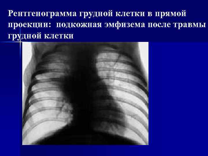 Подкожная эмфизема. Подкожная эмфизема грудной клетки рентген. Эмфизема мягких тканей грудной клетки. Подкожная эмфизема на рентгенограмме. Рентгенография грудной клетки в прямой проекции.