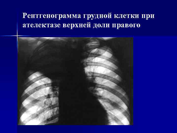 Рентгенограмма грудной клетки при ателектазе верхней доли правого 