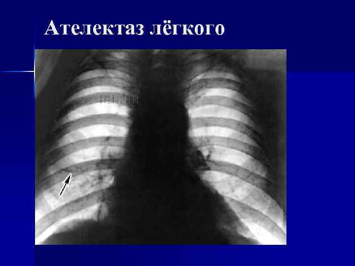 Ателектаз лёгкого 